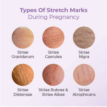 Types Of Stretch Marks During Pregnancy